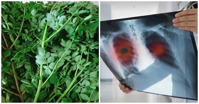 Bs Việt lý giải về công bố của Mỹ: rau chùm ngây tiêu diệt 93% tế bào ung thư phổi trong 2 ngày